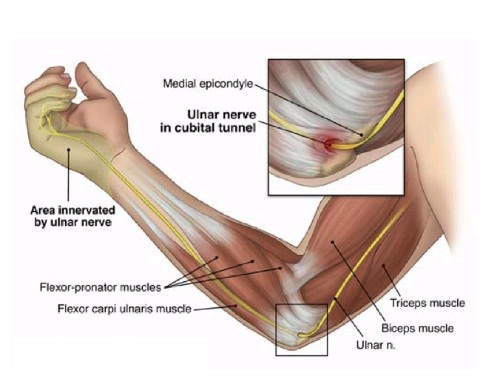 EMG Best Test To Diagnose Cubital Tunnel